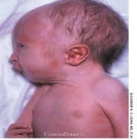 نقص های مادرزادی- انواع سندرم ادواردز